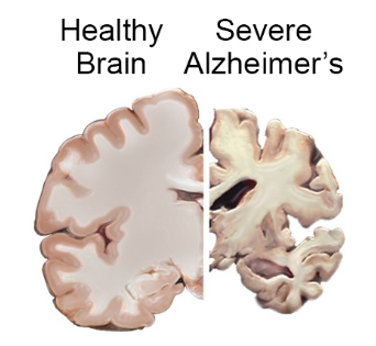 alzheimers-brain