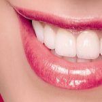 Everything You Need To Know About Caring For Porcelain Veneers