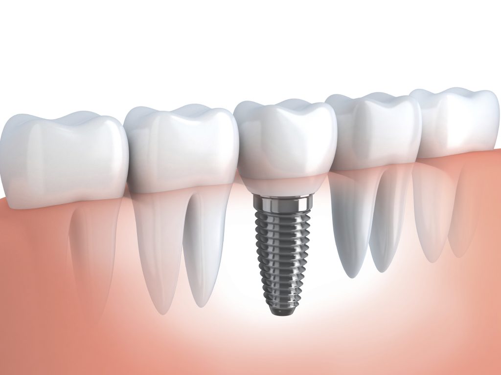 Dental Implants – A Perfect Solution For A Happy, Healthy Teeth